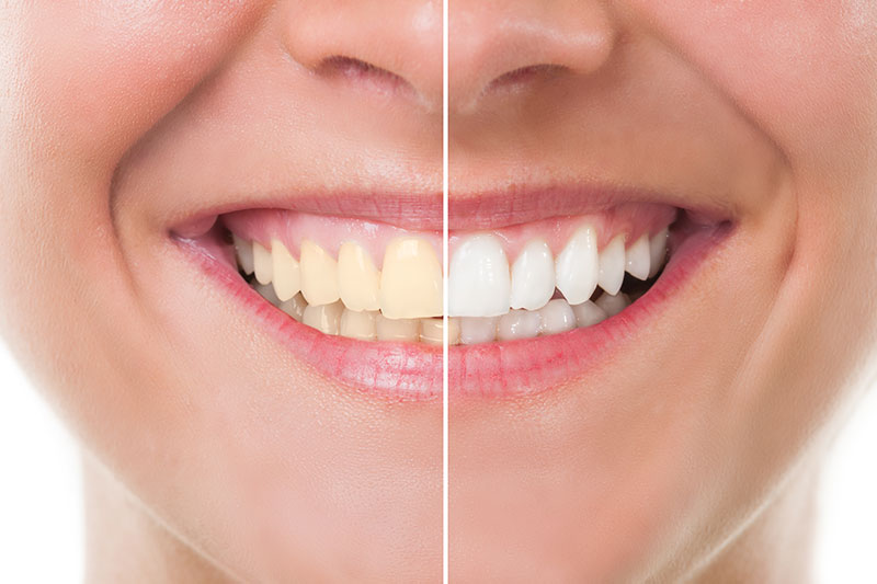 Teeth Whitening in Encinitas